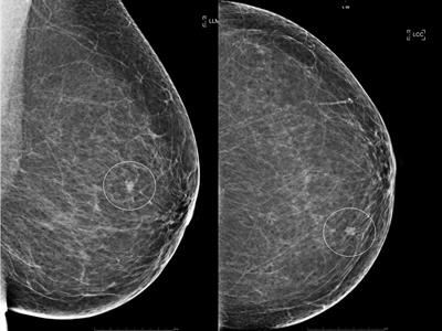 Case Report: Intraoperative radiotherapy as the new standard of care for breast cancer patients with disabling health conditions or impairments